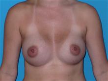 Breast Augmentation After Photo by Patrick Chen, MD; Fort Worth, TX - Case 25853