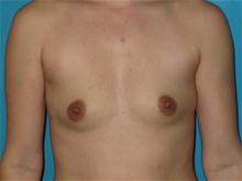 Breast Augmentation Before Photo by Patrick Chen, MD; Fort Worth, TX - Case 25853