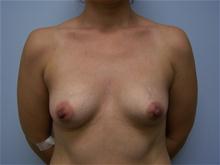 Breast Augmentation Before Photo by Amy Bandy, DO, FACS; Newport Beach, CA - Case 27662