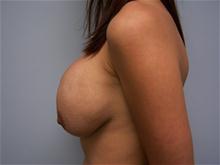 Breast Lift Before Photo by Amy Bandy, DO, FACS; Newport Beach, CA - Case 27663