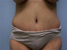 Tummy Tuck After Photo by Amy Bandy, DO, FACS; Newport Beach, CA - Case 27664