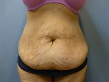 Tummy Tuck Before Photo by Amy Bandy, DO, FACS; Newport Beach, CA - Case 27664