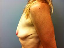Breast Lift Before Photo by Amy Bandy, DO, FACS; Newport Beach, CA - Case 27666