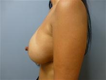 Breast Augmentation After Photo by Amy Bandy, DO, FACS; Newport Beach, CA - Case 27667