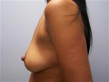 Breast Augmentation Before Photo by Amy Bandy, DO, FACS; Newport Beach, CA - Case 27667