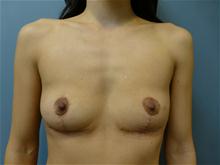 Breast Reduction After Photo by Amy Bandy, DO, FACS; Newport Beach, CA - Case 27672