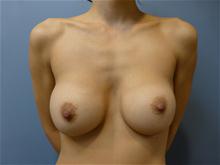 Breast Reduction Before Photo by Amy Bandy, DO, FACS; Newport Beach, CA - Case 27672