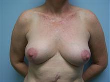 Breast Reduction After Photo by Amy Bandy, DO, FACS; Newport Beach, CA - Case 27673