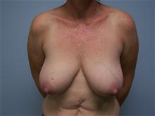 Breast Reduction Before Photo by Amy Bandy, DO, FACS; Newport Beach, CA - Case 27673