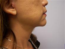 Facelift After Photo by Amy Bandy, DO, FACS; Newport Beach, CA - Case 27675