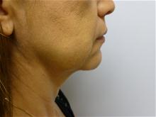 Facelift Before Photo by Amy Bandy, DO, FACS; Newport Beach, CA - Case 27675