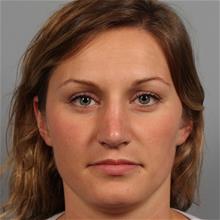 Rhinoplasty After Photo by Gregory Mackay, MD; Atlanta, GA - Case 29746
