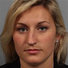 Rhinoplasty Before Photo by Gregory Mackay, MD; Atlanta, GA - Case 29746