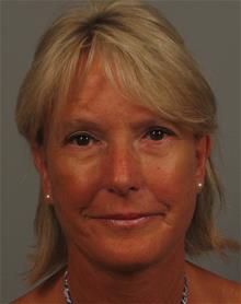 Facelift After Photo by Gregory Mackay, MD; Atlanta, GA - Case 29749