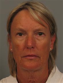 Facelift Before Photo by Gregory Mackay, MD; Atlanta, GA - Case 29749