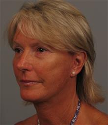 Facelift After Photo by Gregory Mackay, MD; Atlanta, GA - Case 29749