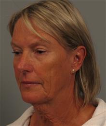 Facelift Before Photo by Gregory Mackay, MD; Atlanta, GA - Case 29749