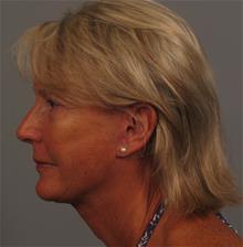Facelift After Photo by Gregory Mackay, MD; Atlanta, GA - Case 29749