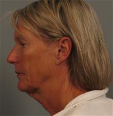 Facelift Before Photo by Gregory Mackay, MD; Atlanta, GA - Case 29749