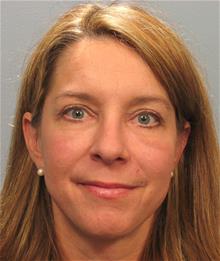 Eyelid Surgery After Photo by Gregory Mackay, MD; Atlanta, GA - Case 29750