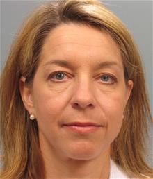 Eyelid Surgery Before Photo by Gregory Mackay, MD; Atlanta, GA - Case 29750