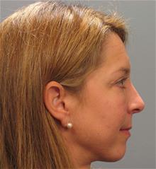 Eyelid Surgery After Photo by Gregory Mackay, MD; Atlanta, GA - Case 29750