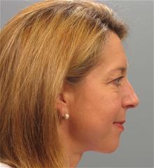 Eyelid Surgery Before Photo by Gregory Mackay, MD; Atlanta, GA - Case 29750