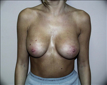Breast Augmentation After Photo by David Abramson, MD; Englewood, NJ - Case 25171