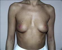Breast Augmentation Before Photo by David Abramson, MD; Englewood, NJ - Case 25171