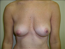 Breast Augmentation Before Photo by David Abramson, MD; Englewood, NJ - Case 25175