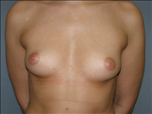 Breast Augmentation Before Photo by David Abramson, MD; Englewood, NJ - Case 25177