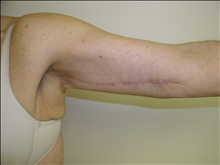 Arm Lift After Photo by David Abramson, MD; Englewood, NJ - Case 25179