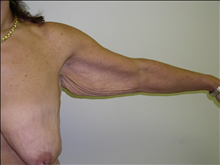 Arm Lift Before Photo by David Abramson, MD; Englewood, NJ - Case 25179