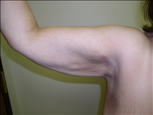 Arm Lift After Photo by David Abramson, MD; Englewood, NJ - Case 25180