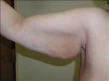 Arm Lift Before Photo by David Abramson, MD; Englewood, NJ - Case 25180