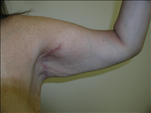 Arm Lift After Photo by David Abramson, MD; Englewood, NJ - Case 25181