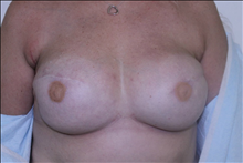 Breast Reconstruction After Photo by David Abramson, MD; Englewood, NJ - Case 25187