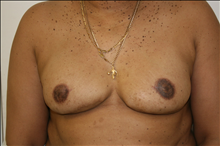 Breast Reconstruction After Photo by David Abramson, MD; Englewood, NJ - Case 25190