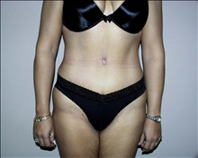 Tummy Tuck After Photo by David Abramson, MD; Englewood, NJ - Case 25192