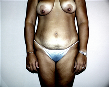 Tummy Tuck Before Photo by David Abramson, MD; Englewood, NJ - Case 25192