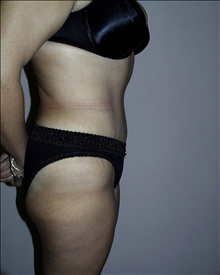 Tummy Tuck After Photo by David Abramson, MD; Englewood, NJ - Case 25192