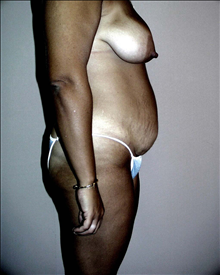 Tummy Tuck Before Photo by David Abramson, MD; Englewood, NJ - Case 25192