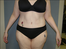 Tummy Tuck After Photo by David Abramson, MD; Englewood, NJ - Case 25194