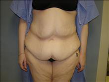 Tummy Tuck Before Photo by David Abramson, MD; Englewood, NJ - Case 25194