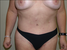 Tummy Tuck After Photo by David Abramson, MD; Englewood, NJ - Case 25197