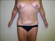 Tummy Tuck Before Photo by David Abramson, MD; Englewood, NJ - Case 25197