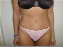 Tummy Tuck After Photo by David Abramson, MD; Englewood, NJ - Case 25199