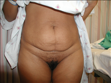 Tummy Tuck Before Photo by David Abramson, MD; Englewood, NJ - Case 25199