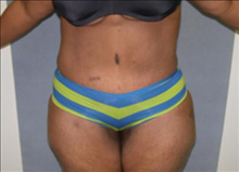 Tummy Tuck After Photo by David Abramson, MD; Englewood, NJ - Case 25202