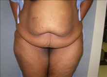 Tummy Tuck Before Photo by David Abramson, MD; Englewood, NJ - Case 25202